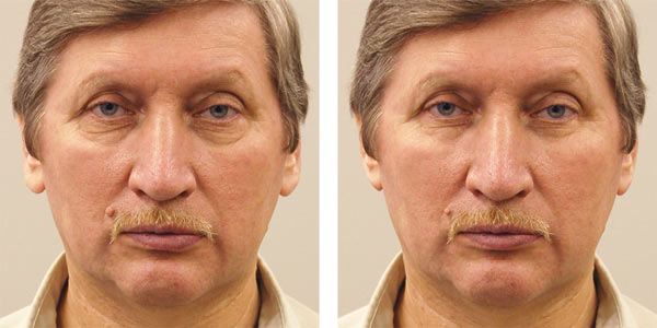 Рис. 21. Исходный портрет мужчины (а) и результат его коррекции фильтром Пластика (б)